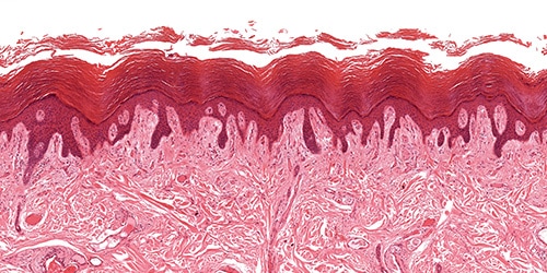 trz-blog-psoriasis-bilimi-500x250