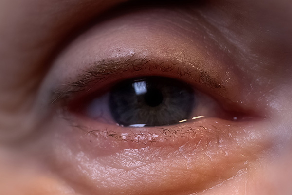 diyabetik-retinopati-600x400